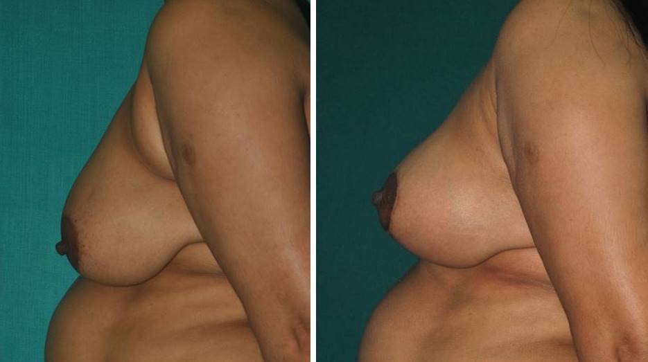 Mastopexy for sagging breasts in India